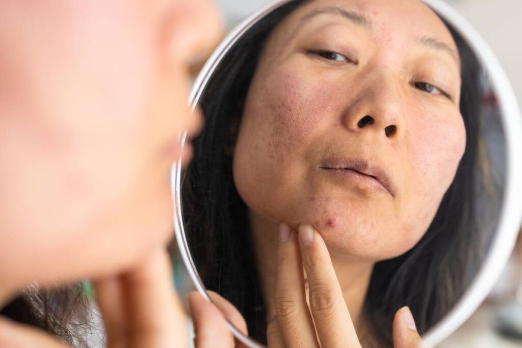 dermatology-puberty-asian-young-woman-girl-looki-2025-03-12-23-59-46-utc (1)